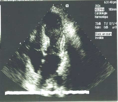 hypokinesis of the apex.